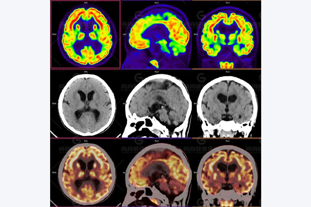 成人癫痫诊断需要做的检查