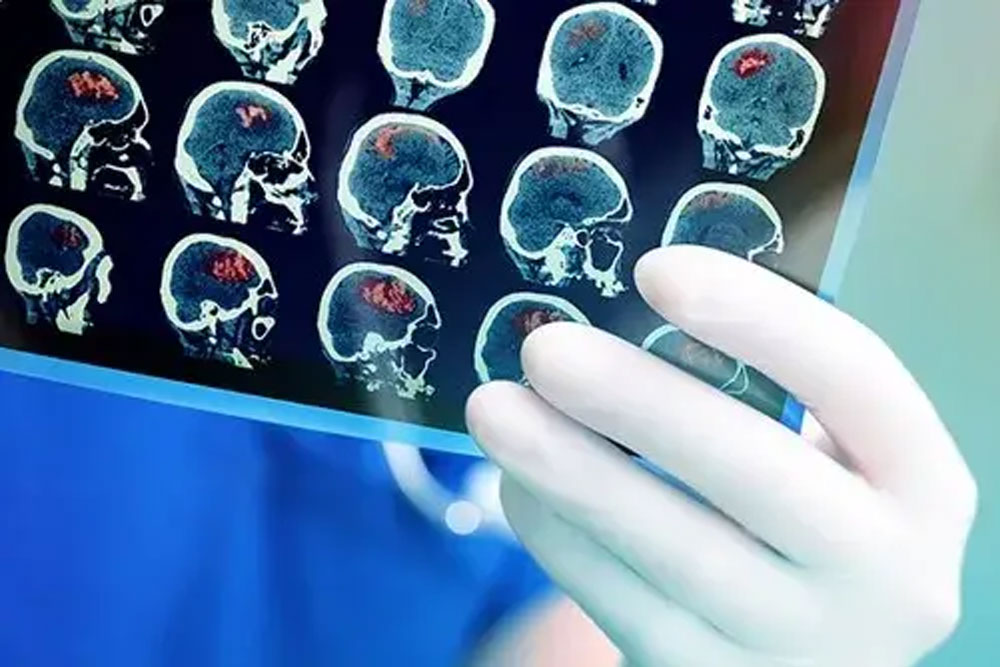 继发性癫痫病怎么引起的?