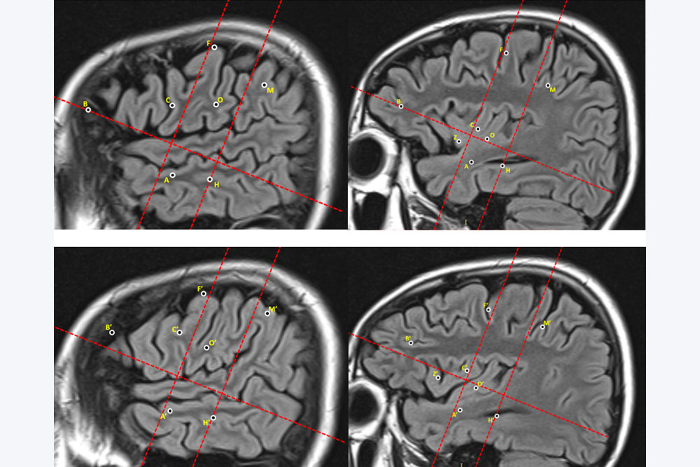 继发性癫痫的严重危害都有哪些呢?