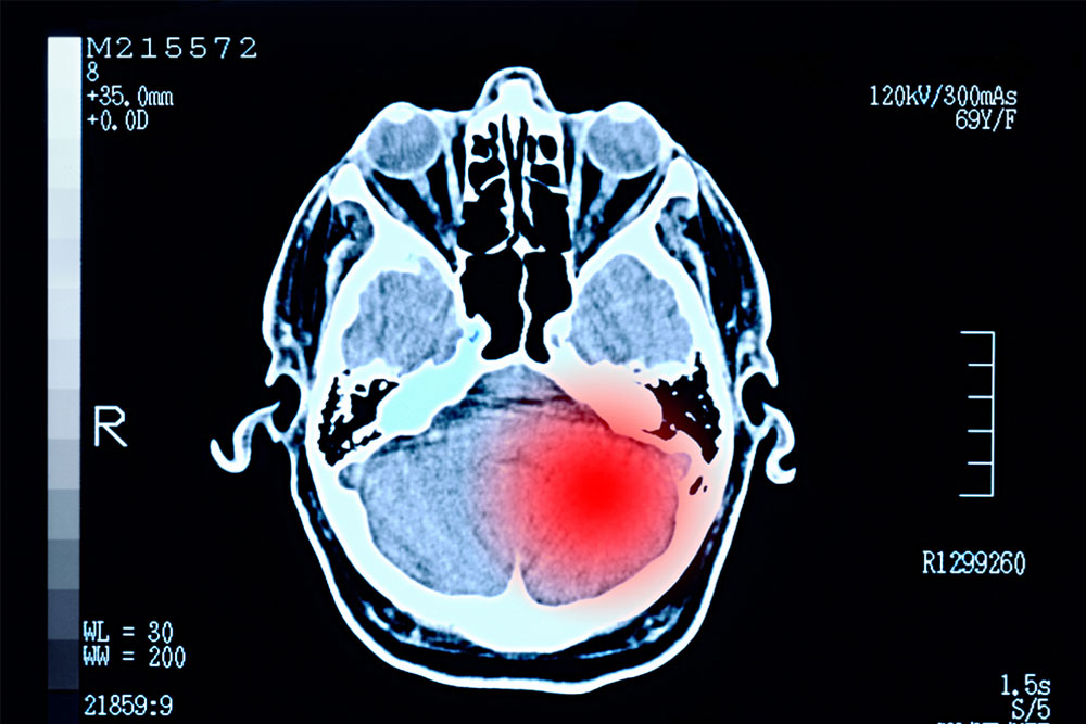 脑损伤癫痫患者应该如何护理?