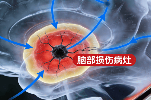 医生说我是“症状性癫痫”，这到底是什么意思?